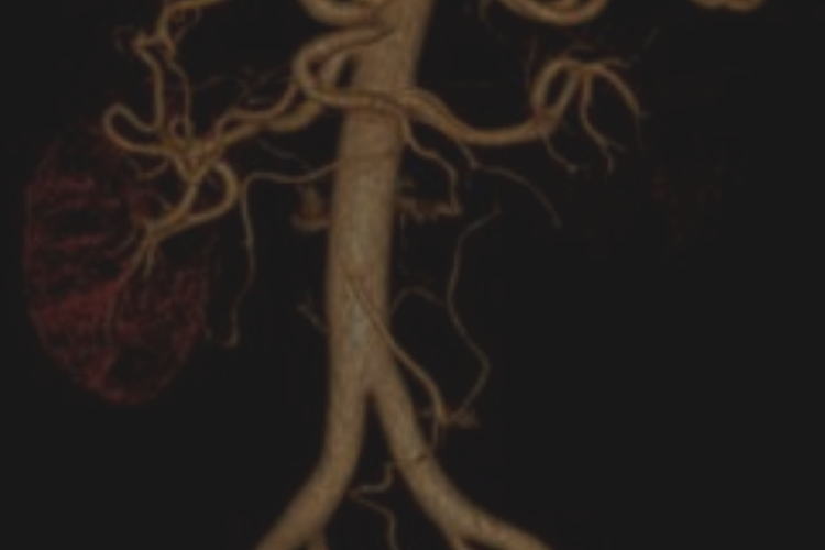 “Entre la duda y la certeza” diagnóstico isquemia mesentérica y otros trastornos de la perfusión abdominal por TCMS