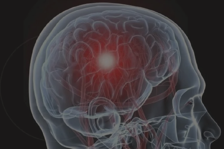 Trombosis venosa cerebral