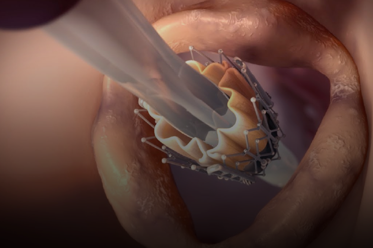 Alternativas transcateter para la insuficiencia mitral: diferentes escenarios clínicos